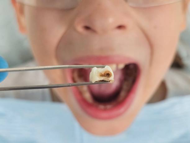 Best Emergency Dental Extractions in Bayport, NY